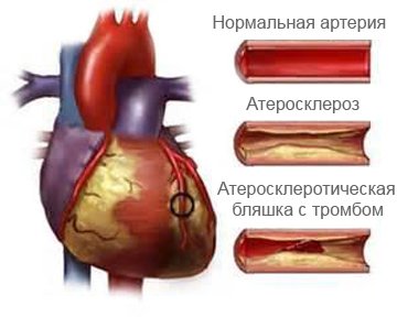 сердечный стент