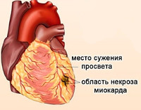Микроинфаркт