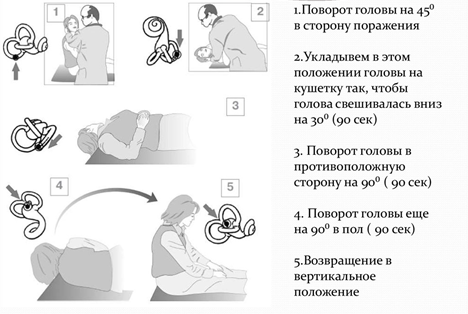 Маневр Эпли